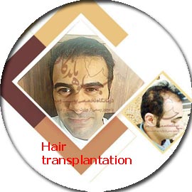 hair-transplantation-beard-mustache-eyebrows