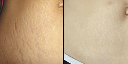 Carboxytherapy کربوکسی تراپی پیکر تراشی رفع چروک بعد از زایمان