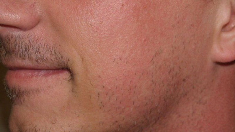 آیا استفاده از موهای صورت برای کاشت ترکیبی ممکن است؟ آیا استفاده از موهای صورت برای کاشت ترکیبی ممکن است؟