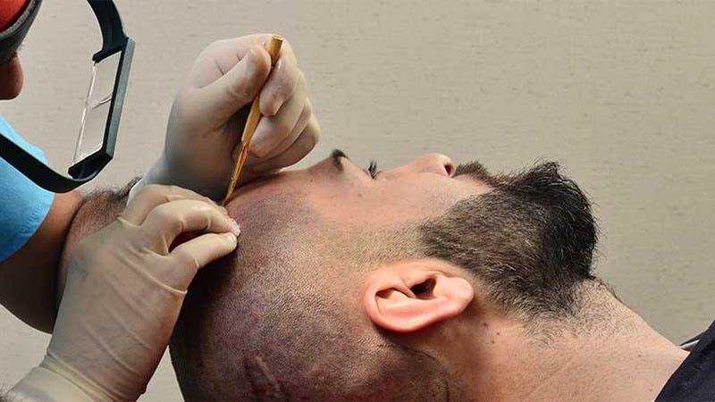 کاشت مو به روش ترکیبی چیست؟ کاشت مو به روش ترکیبی چیست؟