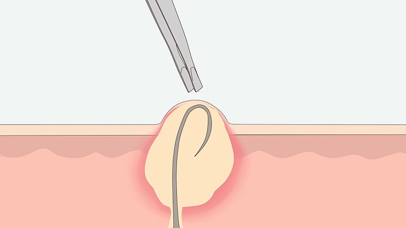 آیا بیرون آمدن موهای زائد زیر پوستی از سطح پوست ممکن است