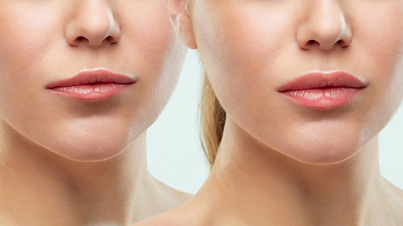 اهمیت جذب مواد تزریق شده در ژل هایی که به لب وارد شده اند اهمیت جذب مواد تزریق شده در ژل هایی که به لب وارد شده اند