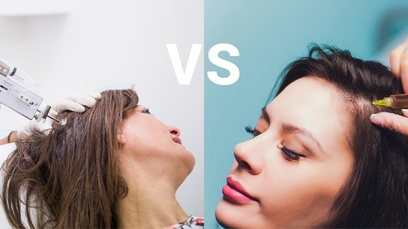 مقایسه مزوتراپی و پی آر پی