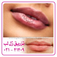 نمونه و عکس تزریق انواع فیلر، ژل، بوتاكس و چربی 