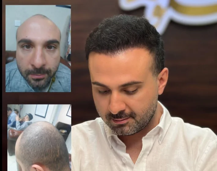 کاشت مو تخصصی به روش میکروگرفت در کلینیک جلوه ماندگار