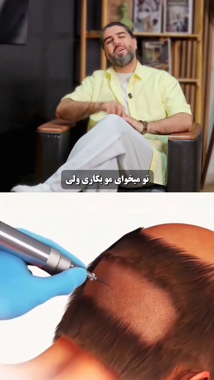 کاشت مو به روش میکروگرفت — کلینیک جلوه ماندگار