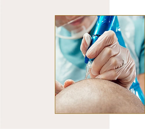 کاشت مو به روش FIT hair transplantation